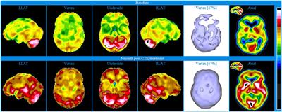 Brain SPECT as an Imaging Biomarker for Evaluating Effects of Novel Treatments in Psychiatry–A Case Series